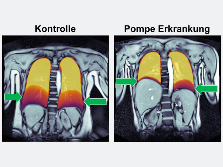 Links ist die Aufnahme eines gesunden Kontrollprobanden zu sehen, rechts die eines Patienten mit Morbus Pompe - Immanuel Klinik Rüdersdorf - Neurologie Links ist die Aufnahme eines gesunden Kontrollprobanden zu sehen, rechts die eines Patienten mit Morbus Pompe - Immanuel Klinik Rüdersdorf - Neurologie